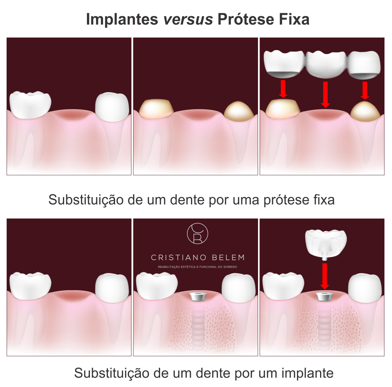 Entendendo a diferença entre prótese e implante dentário
