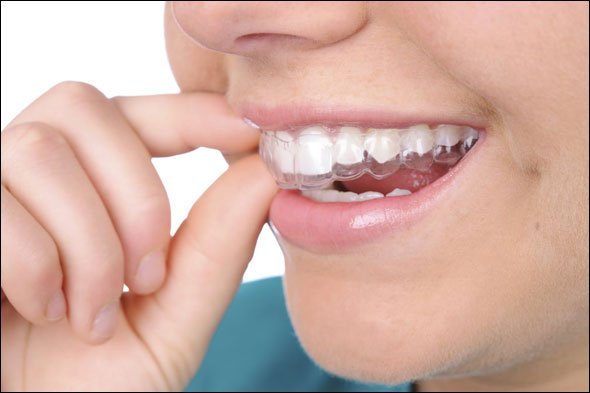 Afinal, como o invisalign corrige a posição dos dentes? - SNG Odontologia