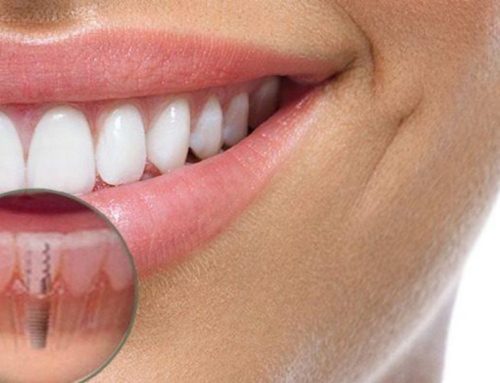 A revolução dos Implantes Dentários – e outras novidades sobre saúde bucal