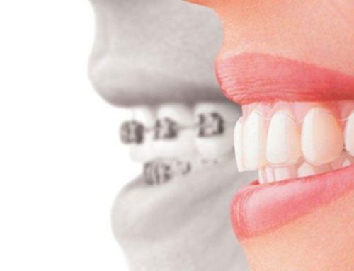 Implante Dentário e Aparelho Ortodôntico combinam?